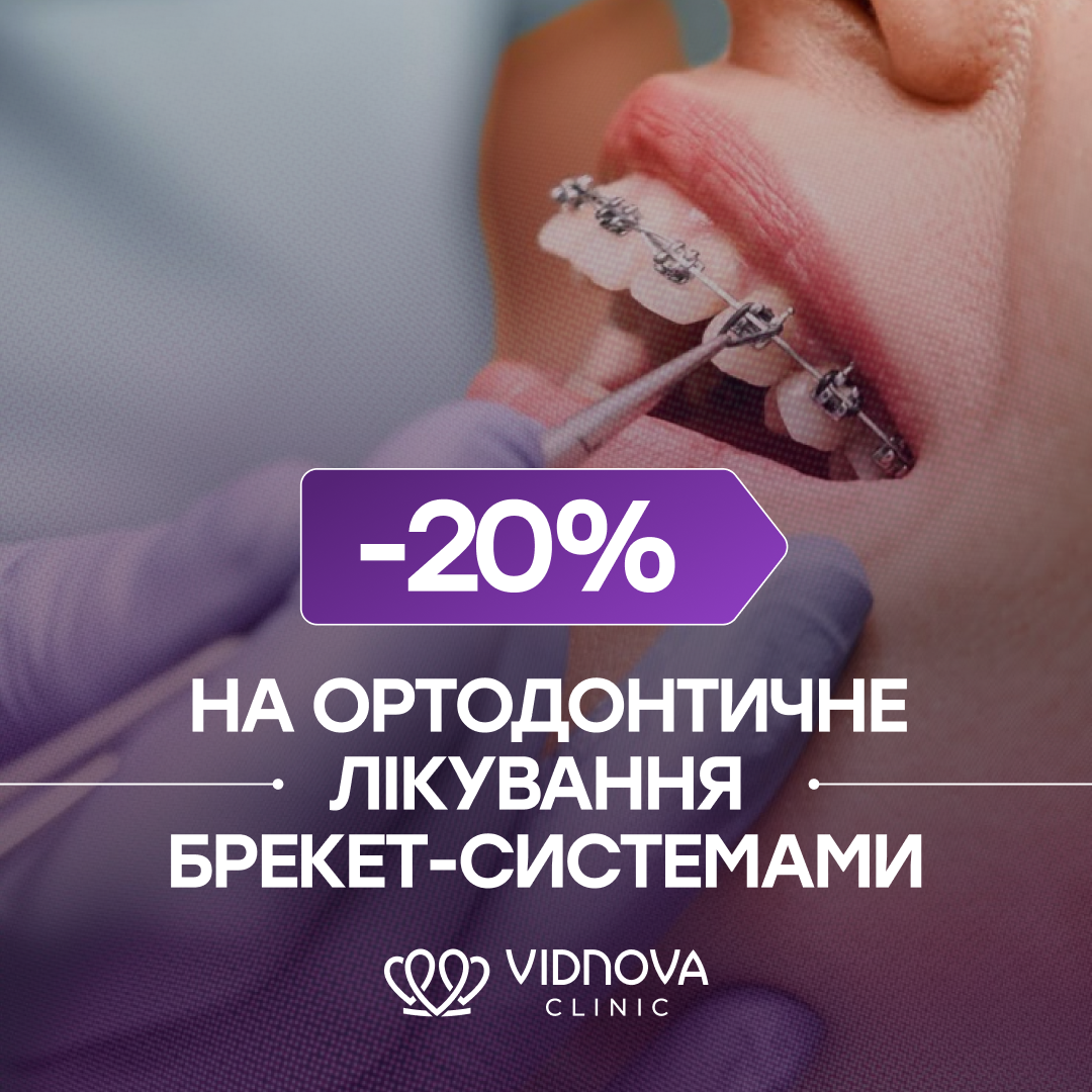 Знижка -20% на брекет-системи
